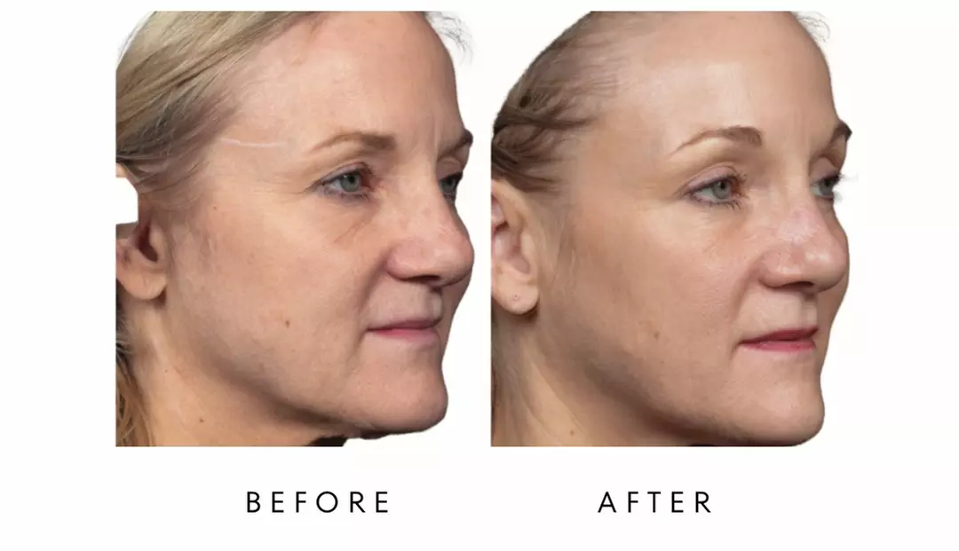 Face-Slim – Non-Invasive Facial Fat Reduction at Your Sculpt Studio DC