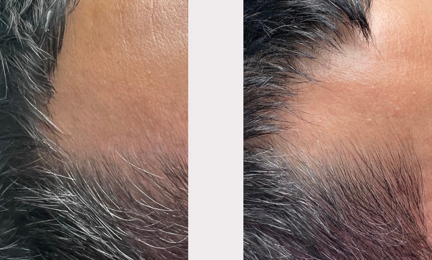 Image 1: Up to 60% Off on Hair Restoration - Non-Surgical at Aesthetics Care Med Spa