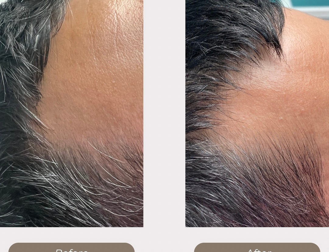 Up to 41% Off on Hair Restoration - Non-Surgical at Aesthetics Care Med Spa