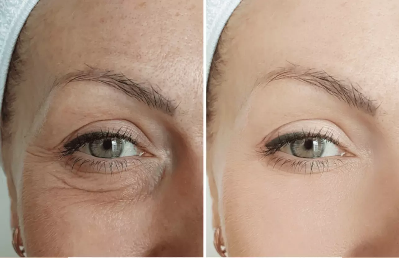 Experience rejuvenating microneedling for face and neck