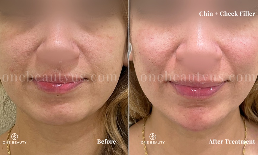 Image 8: Up to 52% Off on Injection - Dermal Filler at One Beauty Aesthetics