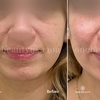 Image 8: Up to 52% Off on Injection - Dermal Filler at One Beauty Aesthetics
