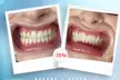 Up to 65% Off on Teeth Whitening at Aesthetics Care Med Spa - Second Medium