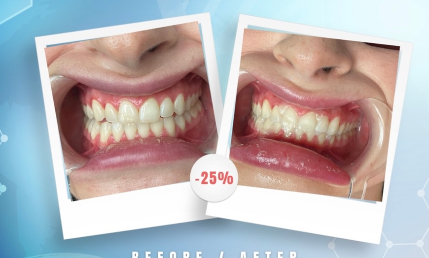 Image 2: Up to 76% Off on Teeth Whitening at Aesthetics Care Med Spa