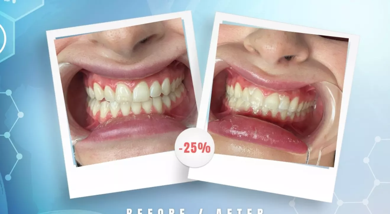 Up to 65% Off on Teeth Whitening at Aesthetics Care Med Spa