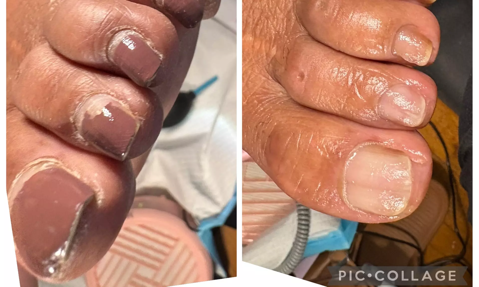 Medical Pedicure, Corn and Callus, Ingrown Toenails, Moisturizer