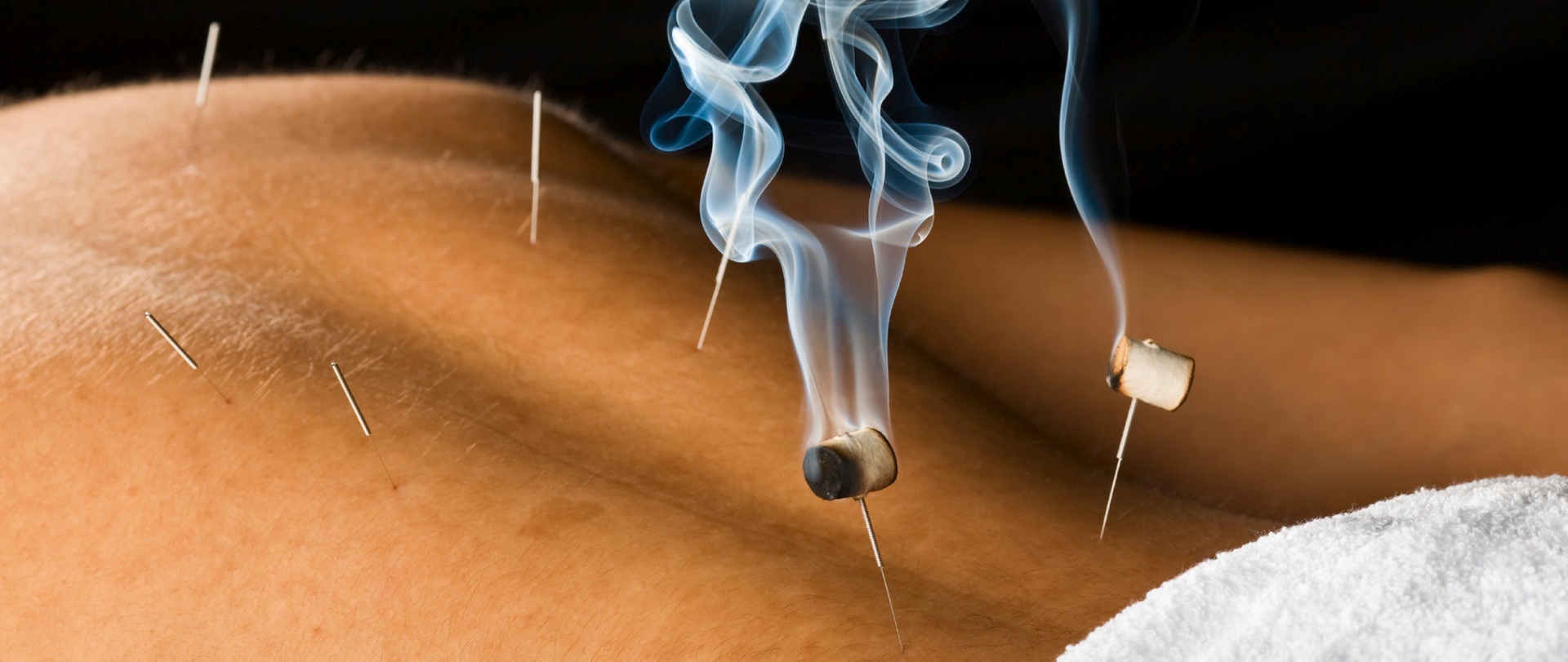 Up to 71% Off on Traditional Chinese Medicine at Remedy Acupuncture Injury Rejuvenation and Pain Management
