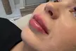 20, 40 or 60 Units of Botox or 1 ML Syringe Versa at Logica Aesthetics (Up to 35% Off) - Second Medium