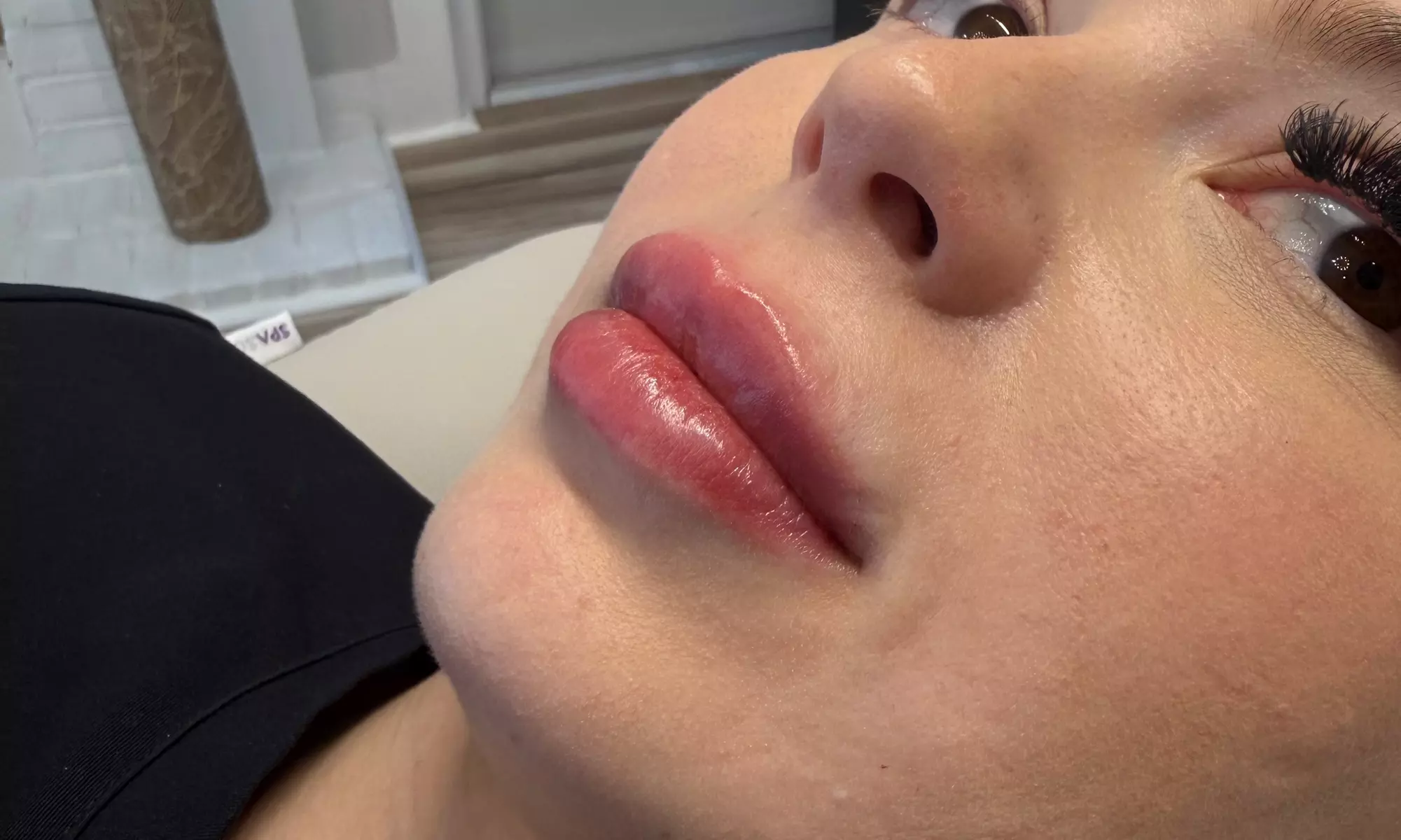 20, 40 or 60 Units of Botox or 1 ML Syringe Versa