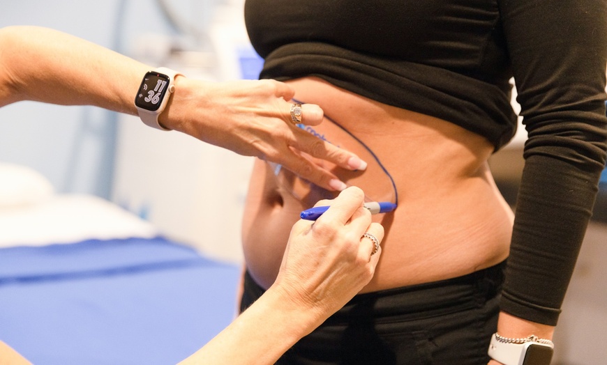 Image 3: Up to 55% Off on Coolsculpting at Florida Cosmetic Center