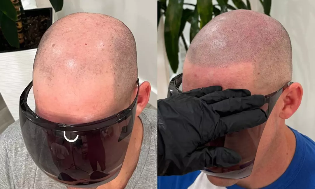 Scalp Micropigmentation: Men’s Hairline (One Session)