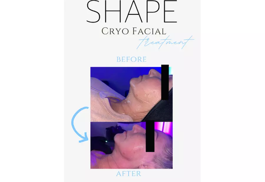Up to 57% Off on Facelift - Non-Surgical at Shape - Primary Image