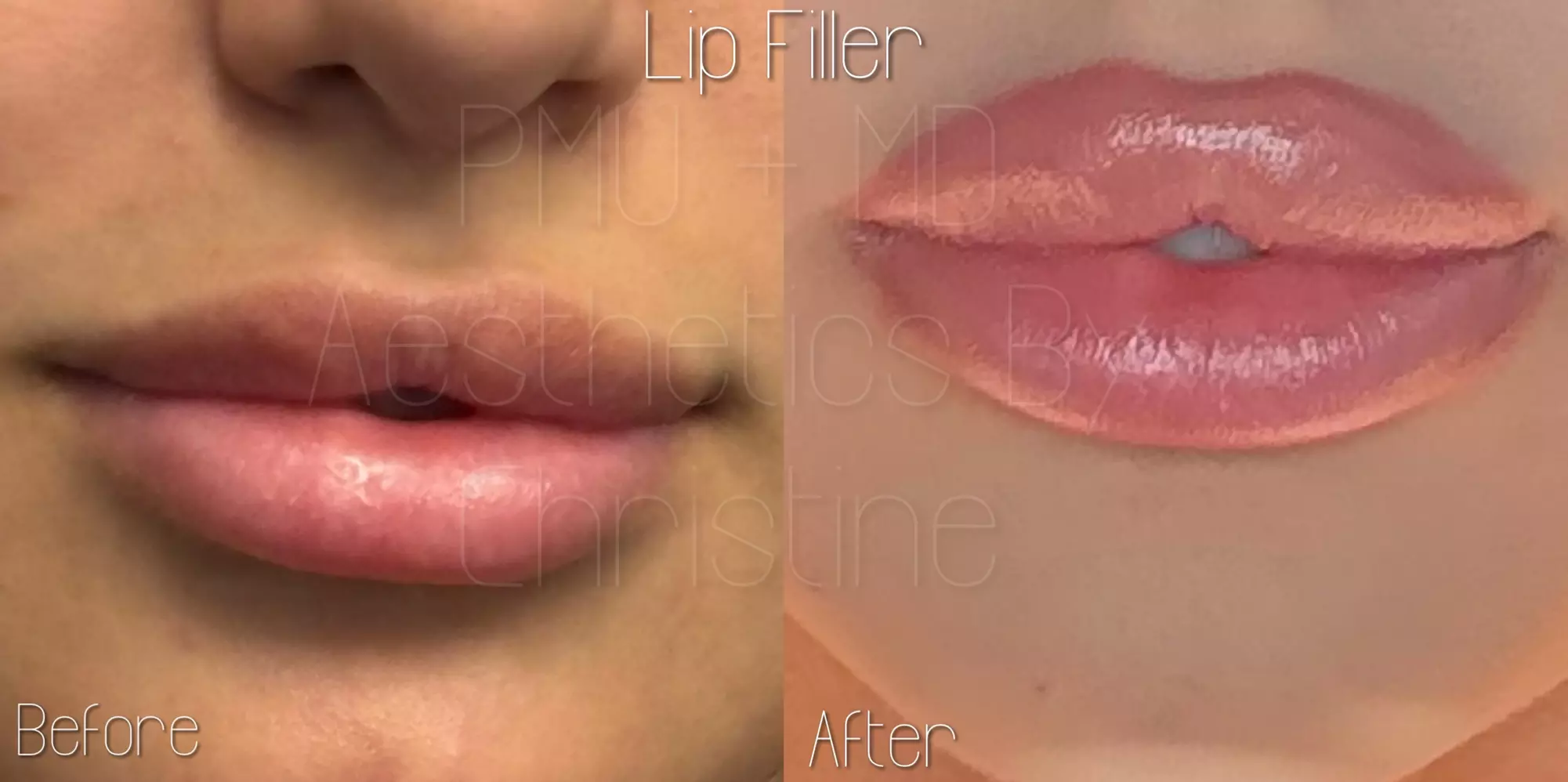 Up to 43% Off on Juvederm Injection - at PMU MD Aesthetics