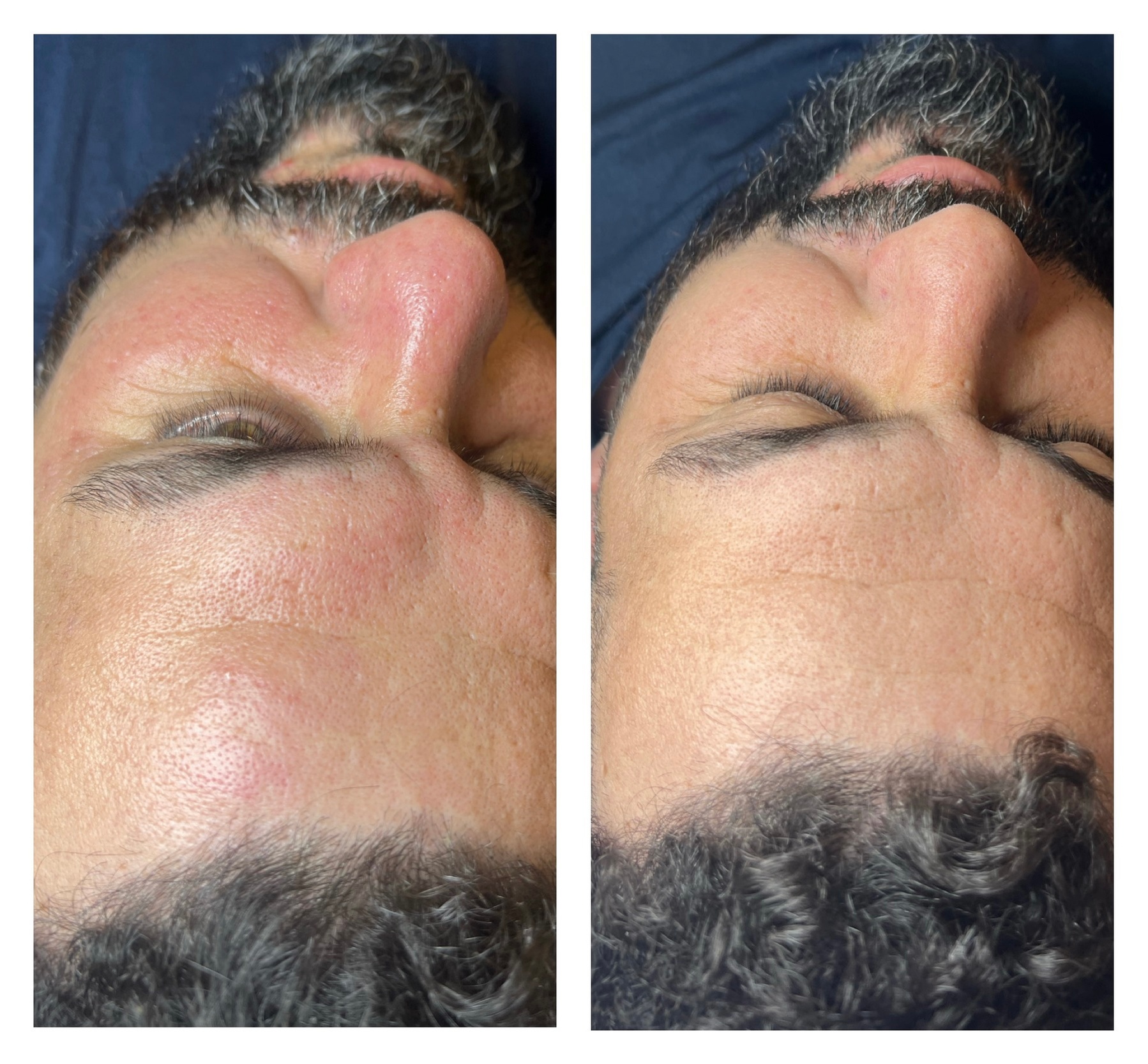 Up to 51% Off on Microdermabrasion at Luana esthetics