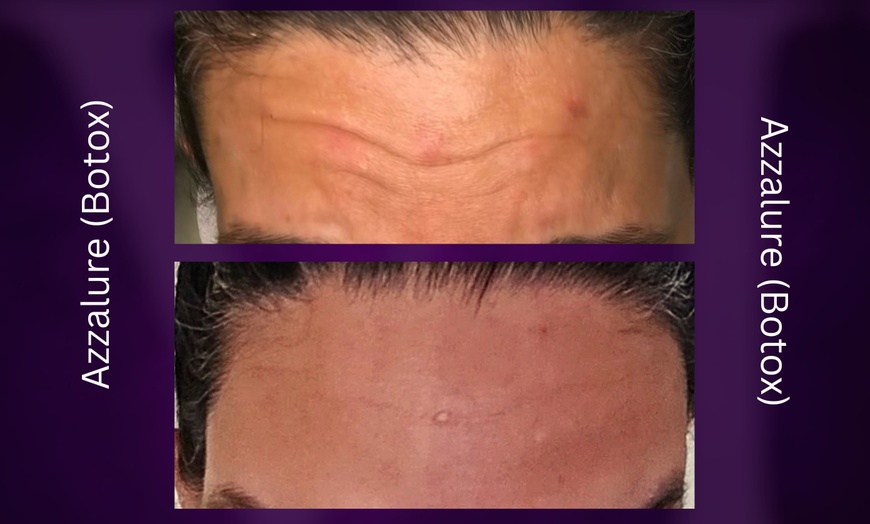 Image 7: Azzalure Skin Booster for Target Frown, Forehead & Eye Wrinkles 