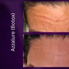 Image 7: Azzalure Skin Booster for Target Frown, Forehead & Eye Wrinkles 