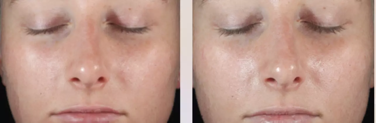 Enhance Your Skin with Deluxe Facial or Laser Diamond Glow Facial (Up to 60% Off) - Second Medium