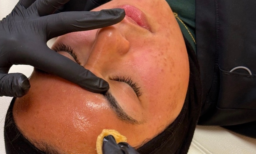 Image 2: Up to 10% Off VI Chemical Peel at Skin Society Medical Spa
