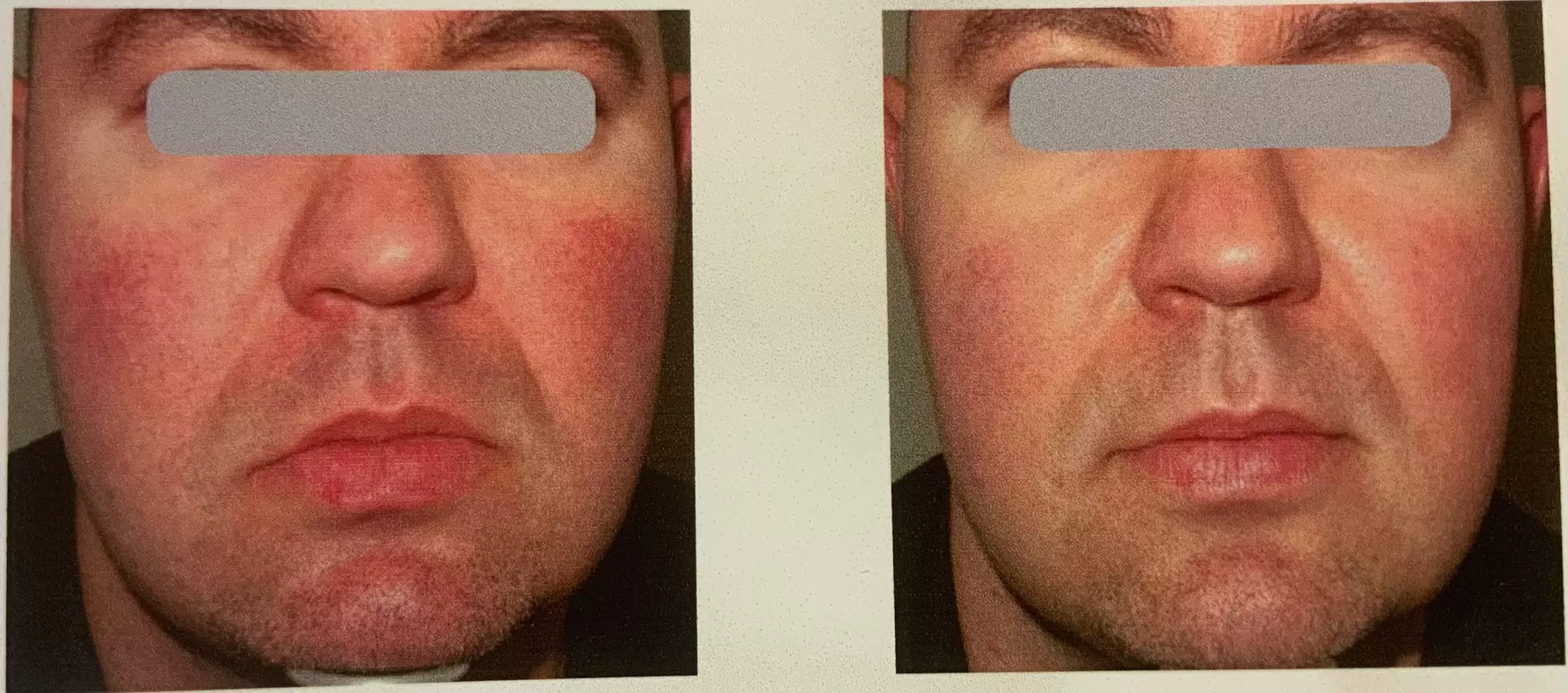 3 or 5 Photorejuvenation Sessions: Full Face w/ or w/o Neck