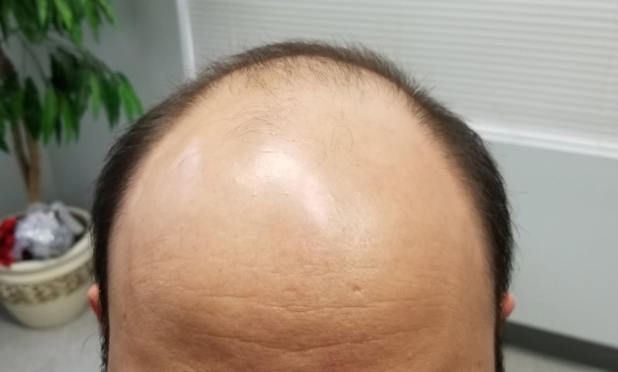 Image 1: $369 or $265 Worth of Non Surgical Hair Replacement