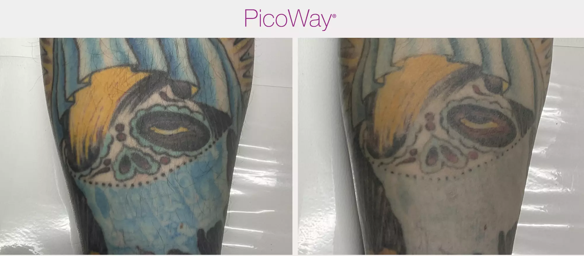 Laser Tattoo & Brow Removal for All Sizes and Skin Types