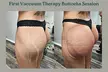 Vacuum Therapy Buttocks and Body Enhancement or CryoStatic Slimming with Vacuum Therapy Combo ( Up to 50% Off ) - Second Medium