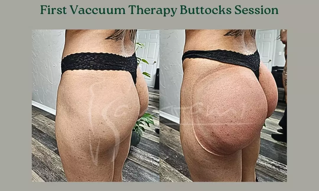 Vacuum Therapy Buttocks & Body Enhancement or CryoStatic Slimming