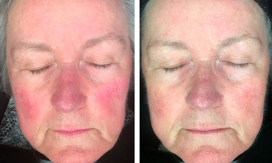 Image 9: Achieve Radiance with 6, 10, or 20 Dermalux MD Triwave LED Therapy 