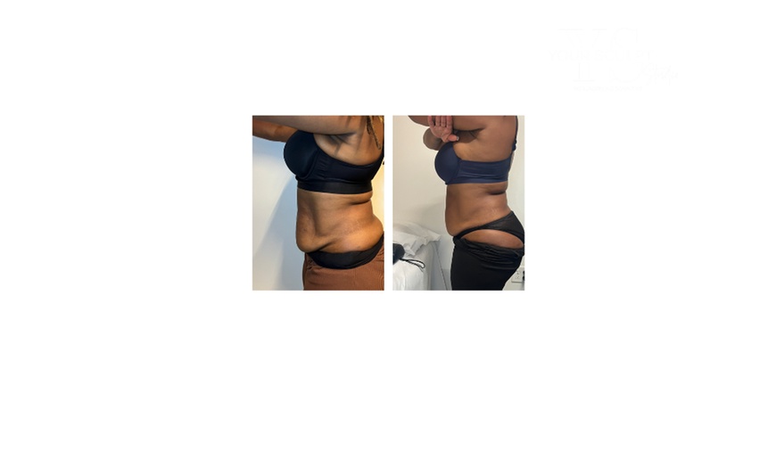 Image 2: Up to 58% Off on Fat Reduction - Non-Branded at Your Sculpt Studio