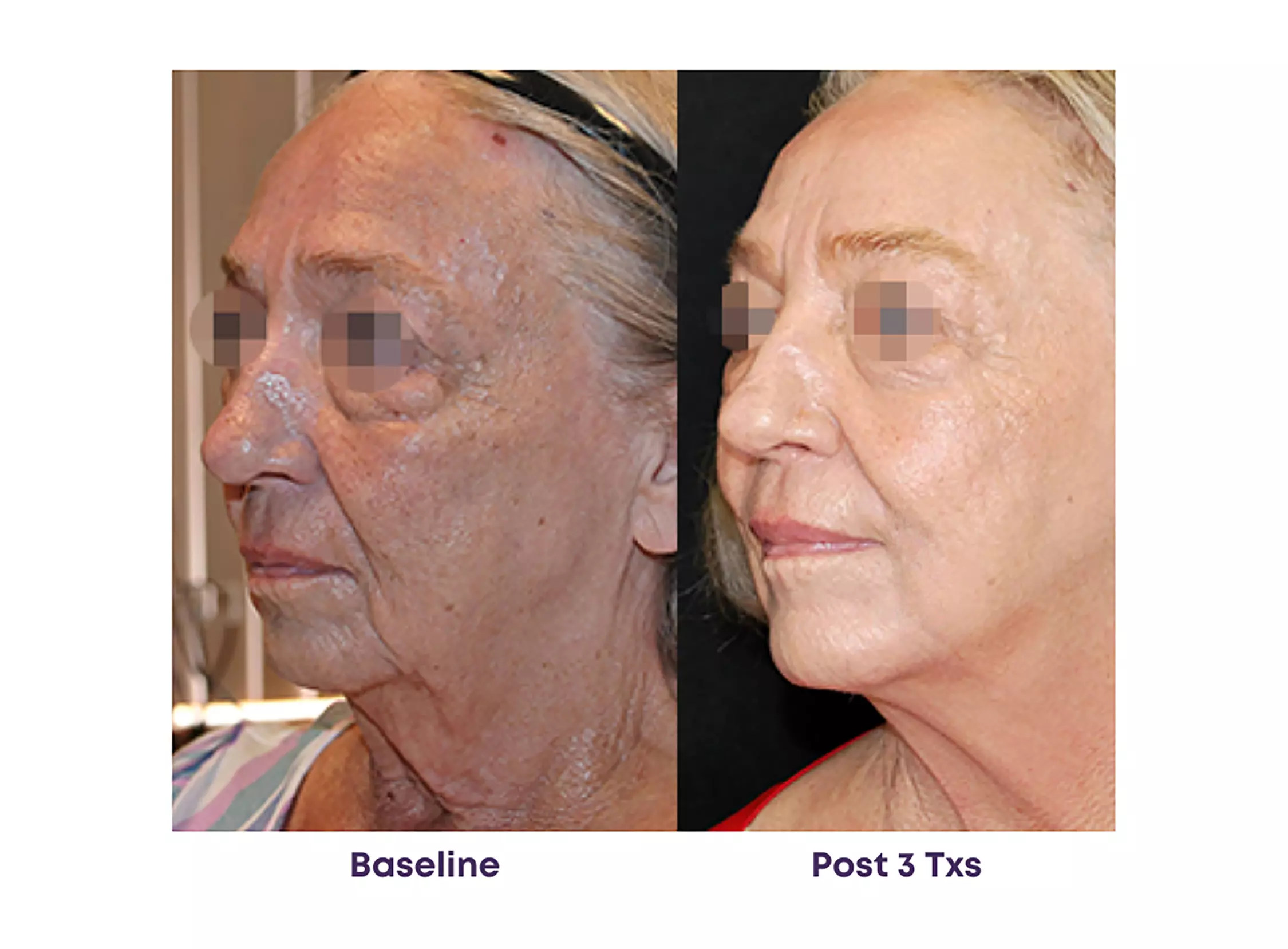 Experience Rewind Advanced Aesthetics'  Skin Tightening for Stomach, Eyes, Neck, or Knees (Up to 37% Off) - Second Medium