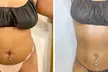 Ultrasonic Cavitation, Non-Invasive Laser Lipo and more at Sound Sculpting Solutions (Up to 69% Off) - Second Medium