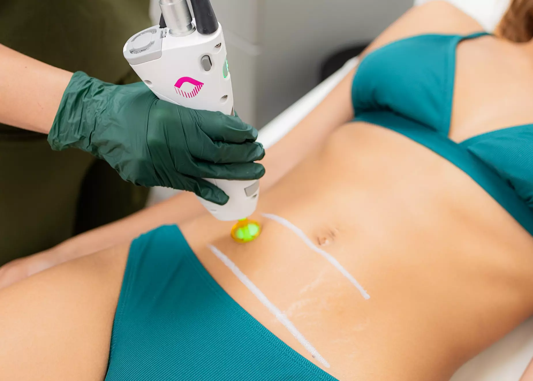 Up to 78% Off on Laser Hair Removal at Lumen Clinic