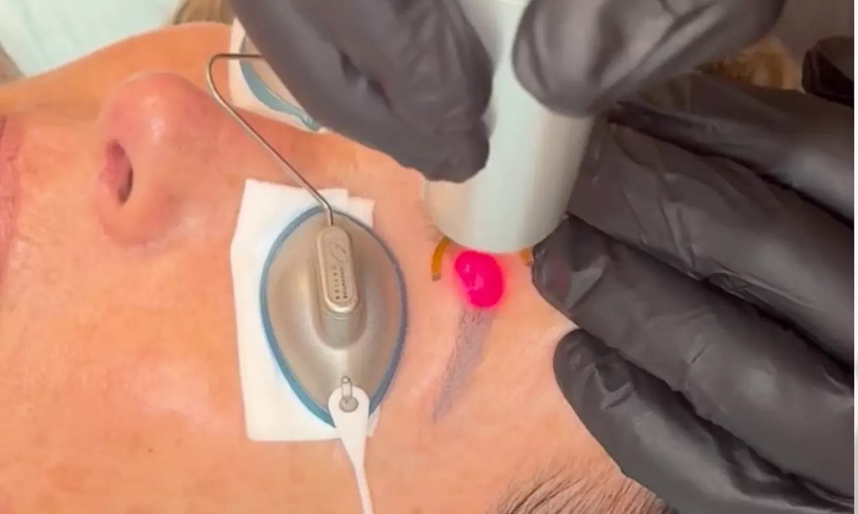 Up to 40% Off on Tattoo Removal at Clarity Tattoo Removal - Second Medium