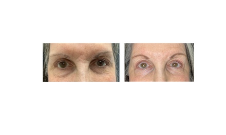One Fibroblast Glabella & Crows feet - Fine Aesthetics