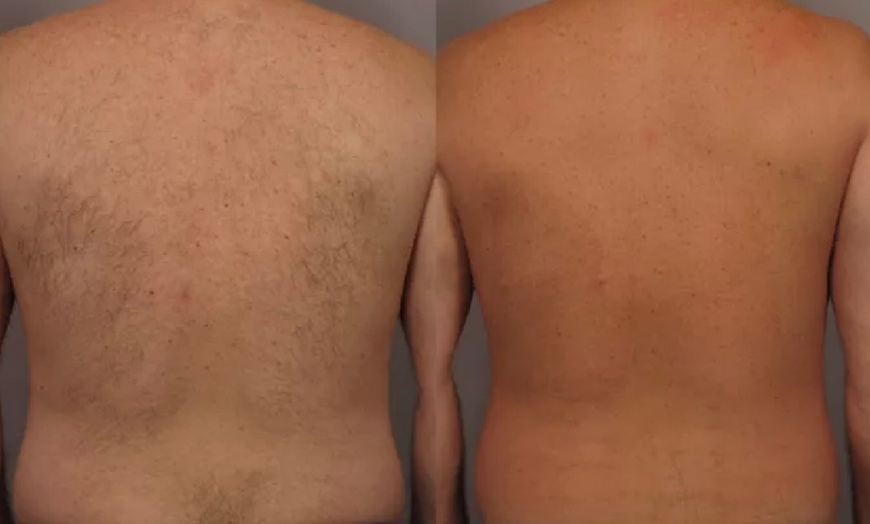 Image 4: Smooth Skin w/ Six Laser Hair Removal on Small, Medium or Large Areas