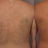 Image 4: Smooth Skin w/ Six Laser Hair Removal on Small, Medium or Large Areas