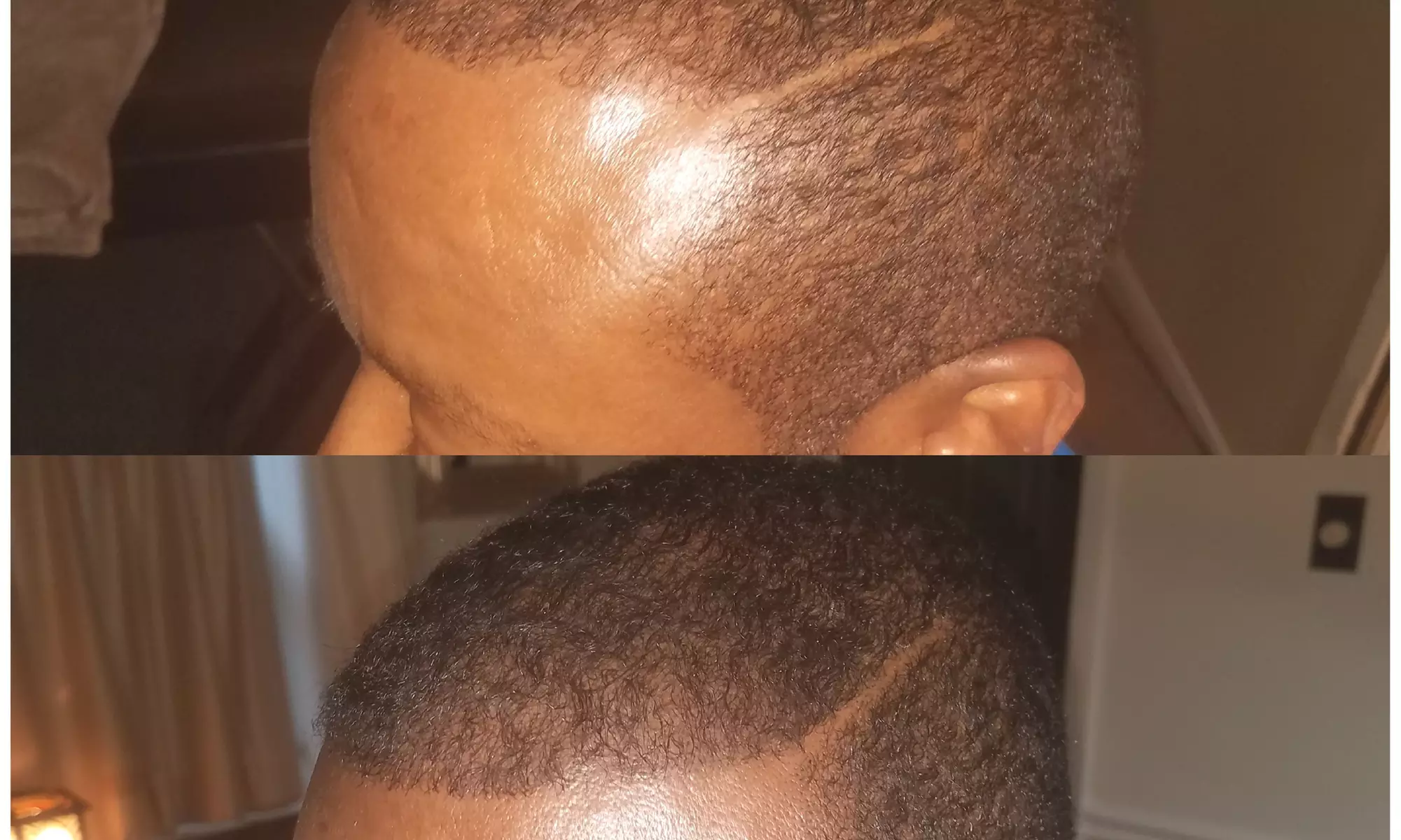 Up to 50% Off on Men and Women's Scalp Micropigmentation