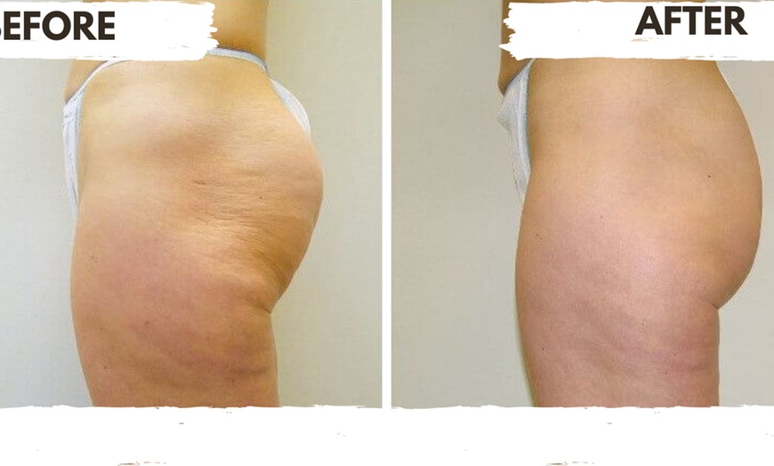 Image 6: Three, Six or Nine Sessions of VelaShape