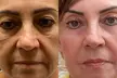 Transform Your Skin with One or Three CO2 Skin-Resurfacing Sessions at Amora Med Spa (Up to 77% Off) - Second Medium