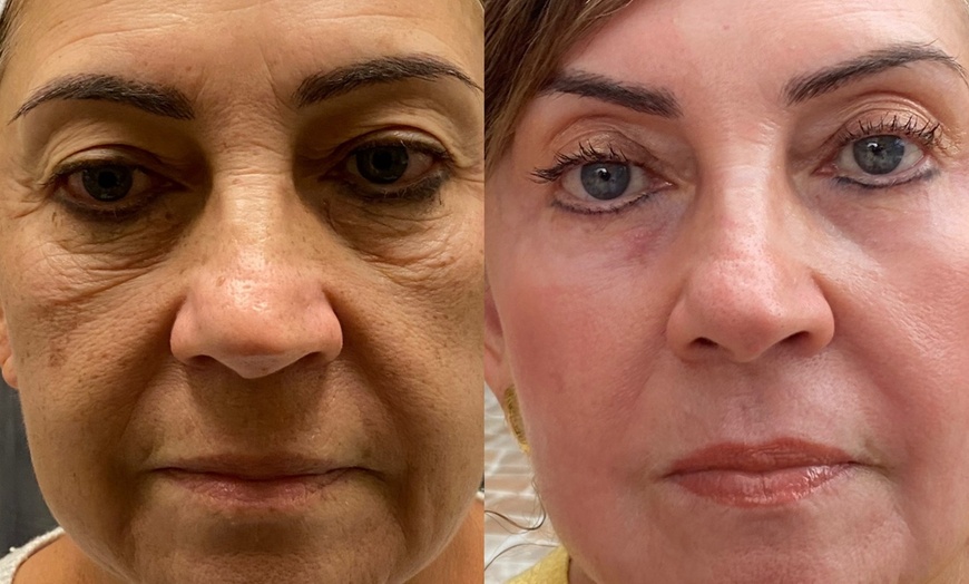 Image 4: Transform Your Skin with One or Three CO2 Skin-Resurfacing Sessions