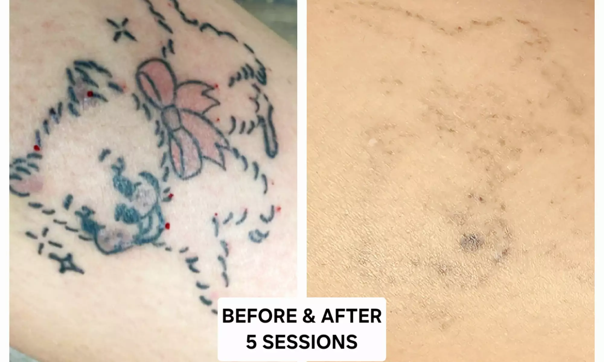 Bellagena Offers Three Laser Tattoo Removal Sessions for Small, X-Small, or XX-Small Areas (Up to 56% Off)
