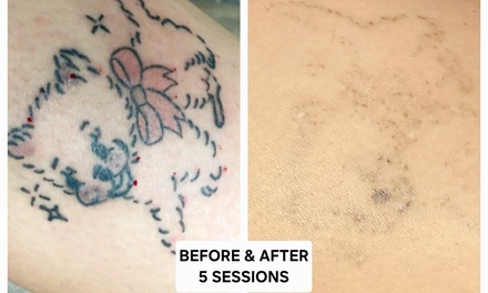Three Laser Tattoo Removal Sessions on a XX-Small Area - Bellagena