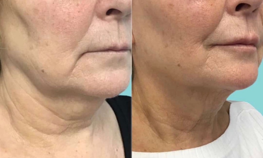 Image 1: Non-Surgical HIFU Treatment for Face Lift or Face and Neck Lift