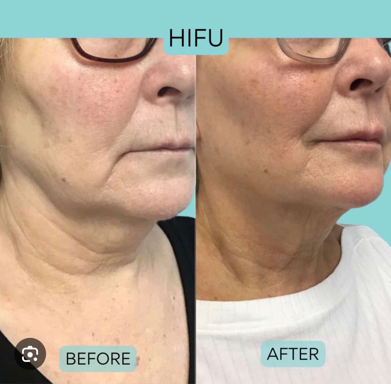 Non-Surgical HIFU Treatment for Face Lift or Face and Neck Lift