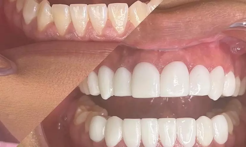 Dental Implant / Corona / Veneer at WHAT-A-SMILE - Primary Image