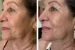 Up to 55% Off on Laser Skin Resurfacing at Amora Med Spa - Second Medium