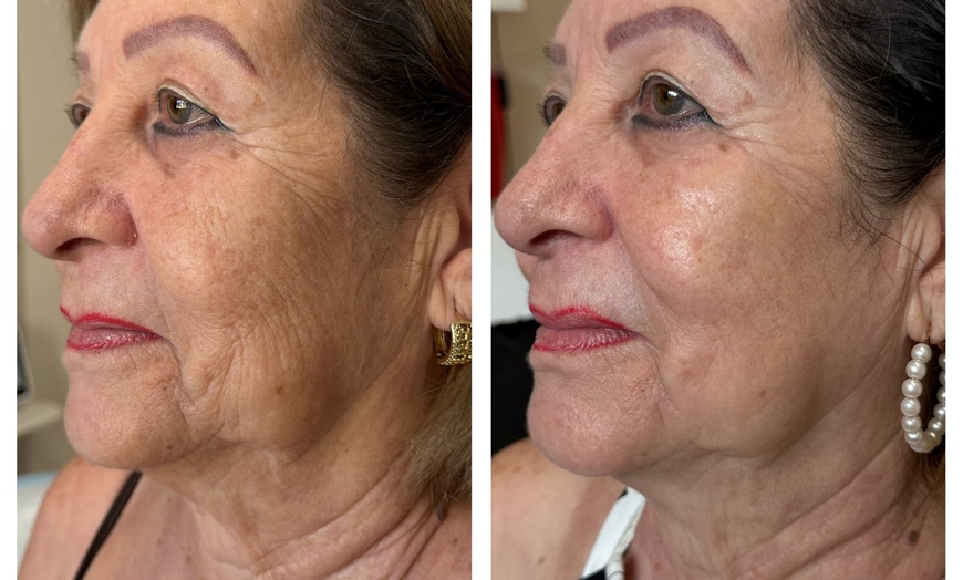 Image 2: Up to 55% Off on Laser Skin Resurfacing at Amora Med Spa