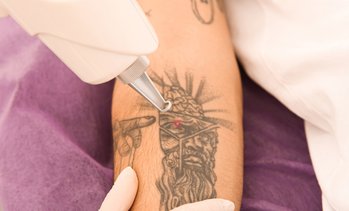 Los Angeles Tattoo Removal - Deals In and Near Los Angeles, CA | Groupon