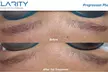 Up to 40% Off on Tattoo Removal at Clarity Tattoo Removal - Second Medium