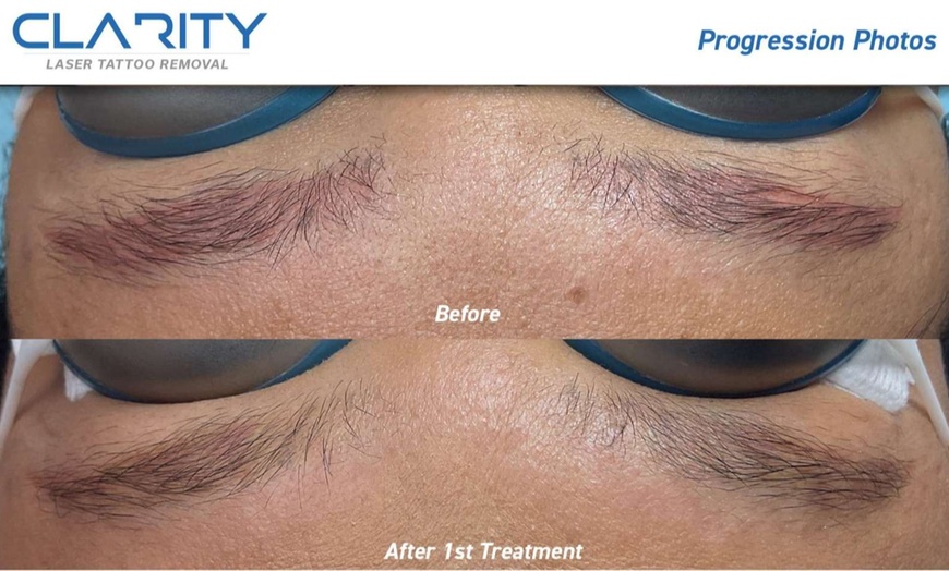 Image 2: Up to 40% Off on Tattoo Removal at Clarity Tattoo Removal